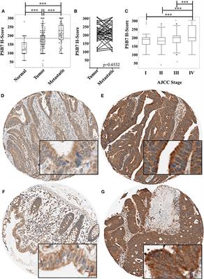 An Investigation Into the Prognostic Significance of High Proteasome PSB7 Protein Expression in Colorectal Cancer